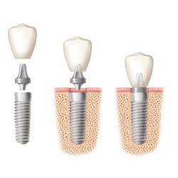 Dental implants in Sydney