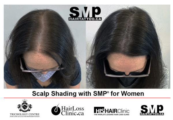 Hair Tattoo Scalp Micropigmentation continues to gain in popularity as an  effective hair loss solution for men and women - Digital Journal