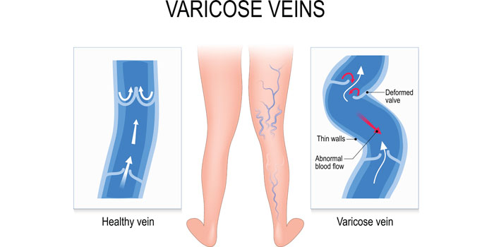 Patients Learn More About Venous Diseases