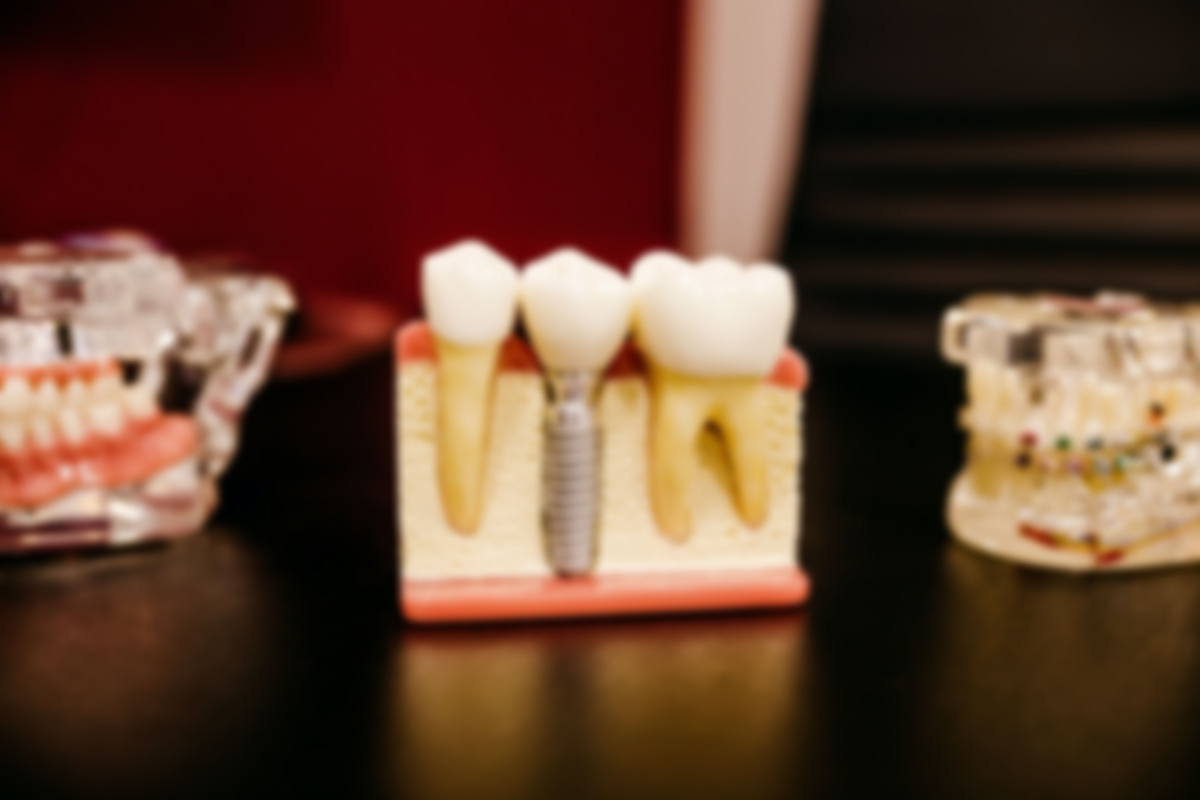 Realtimecampaign.com Discusses Some Important Details about Installing a Dental Implant San Francisco
