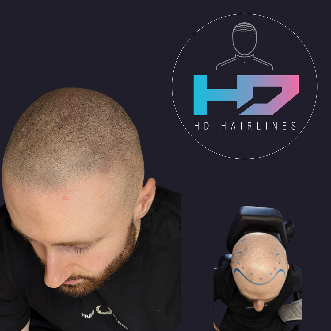 Craig Molyneux discusses scalp micropigmentation, a new permanent solution for hair loss