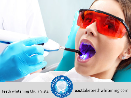 Eastlake Teeth Whitening Now Offer Their Services In San Diego